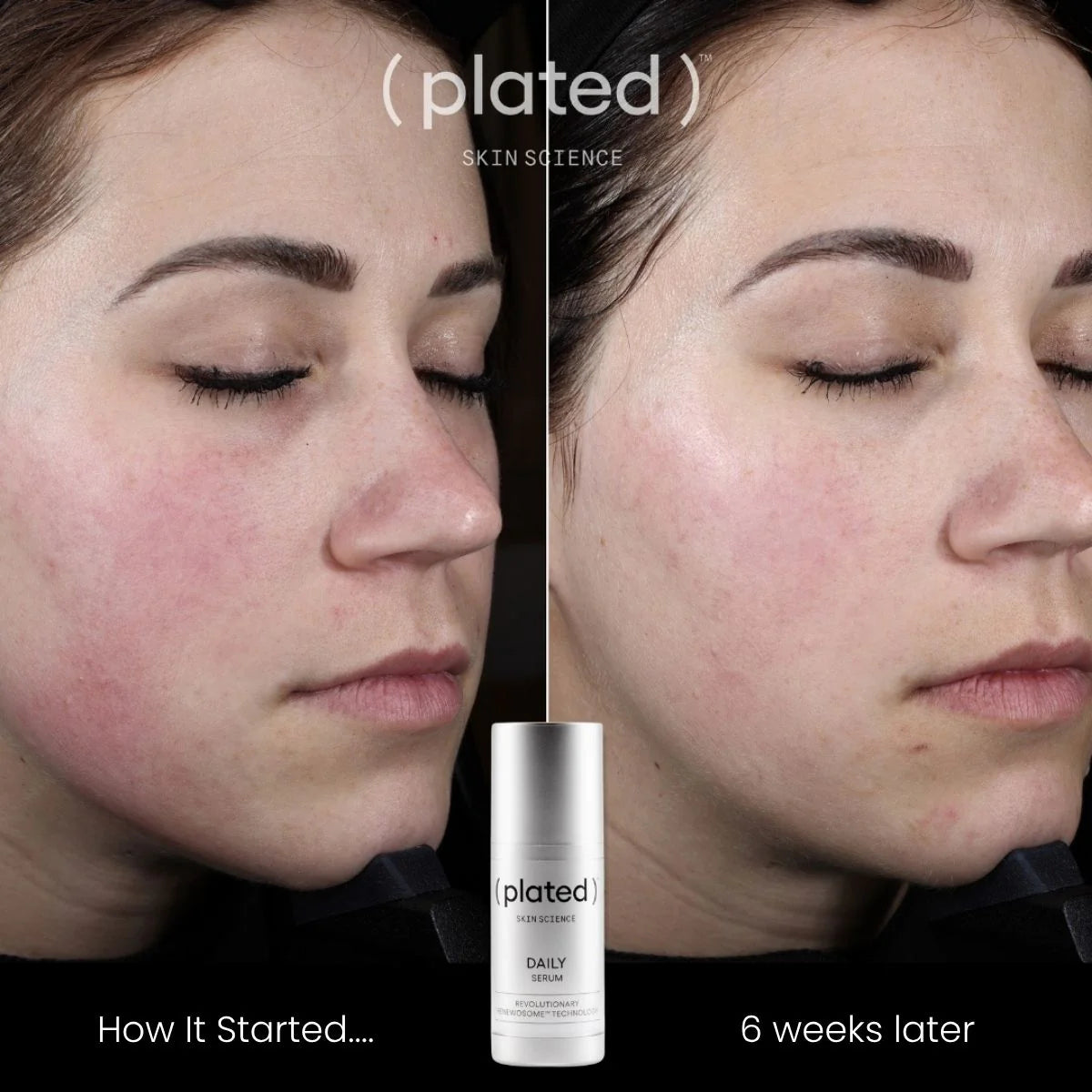Before and after comparison of a person's face with acne, featuring 'plated' skincare product.