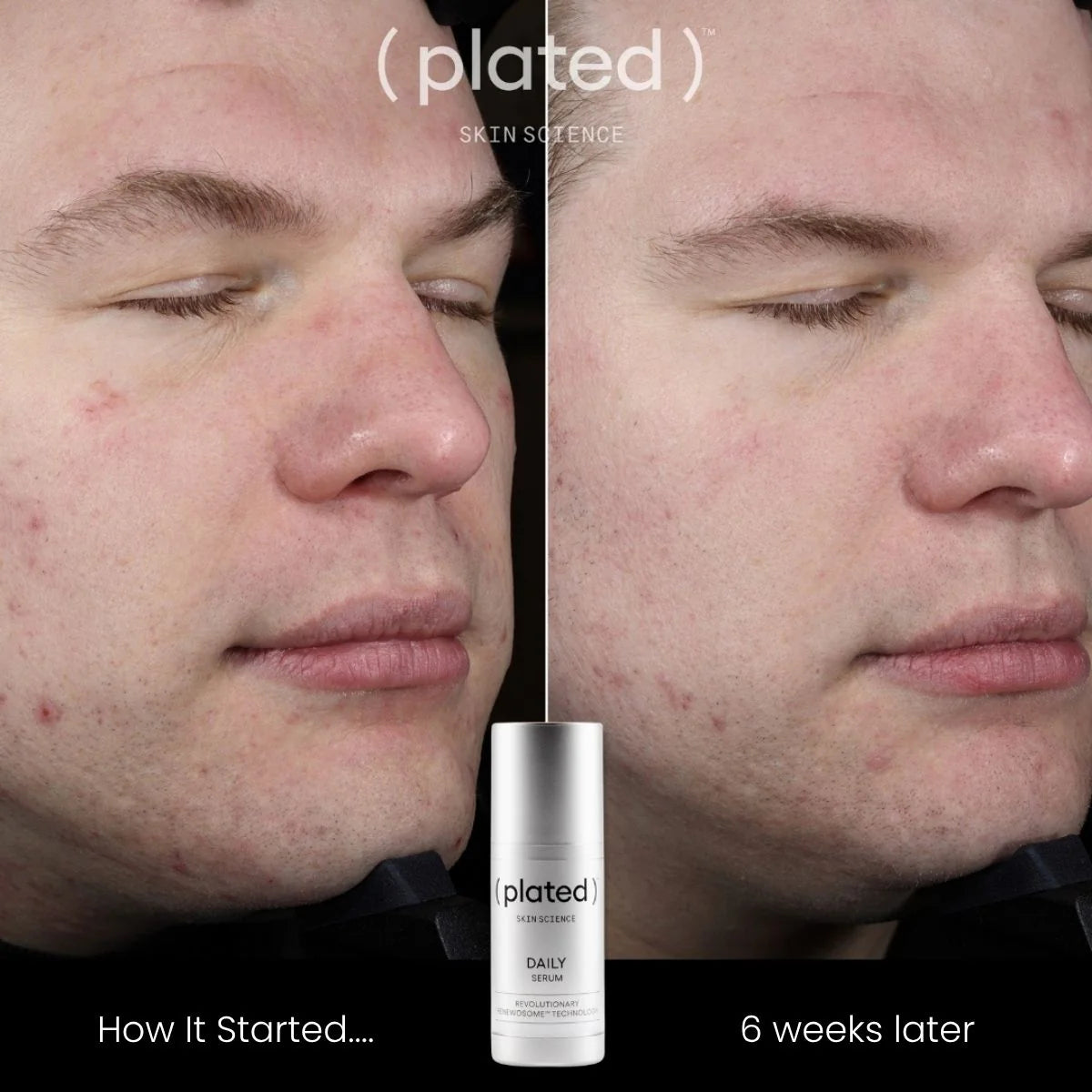 Before and after comparison of a man's face with acne treatment product 'plated' shown.